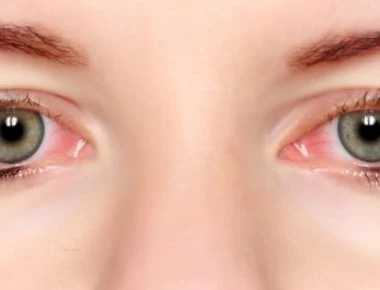 Κοκκινίζουν συχνά τα μάτια σου; - Αιτίες και τρόποι πρόληψης